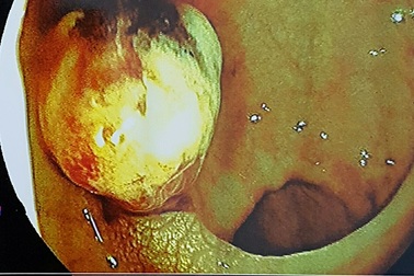 Cảnh giác dấu hiệu đi ngoài ra máu ở trẻ nhỏ