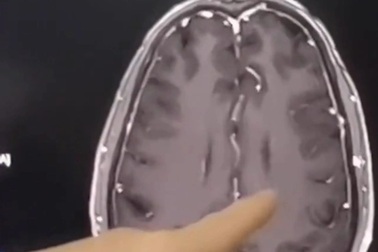 Người đàn ông não chi chít sán chỉ vì một món ăn