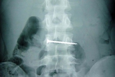 Nuốt đinh vít, bé 2 tuổi tử vong