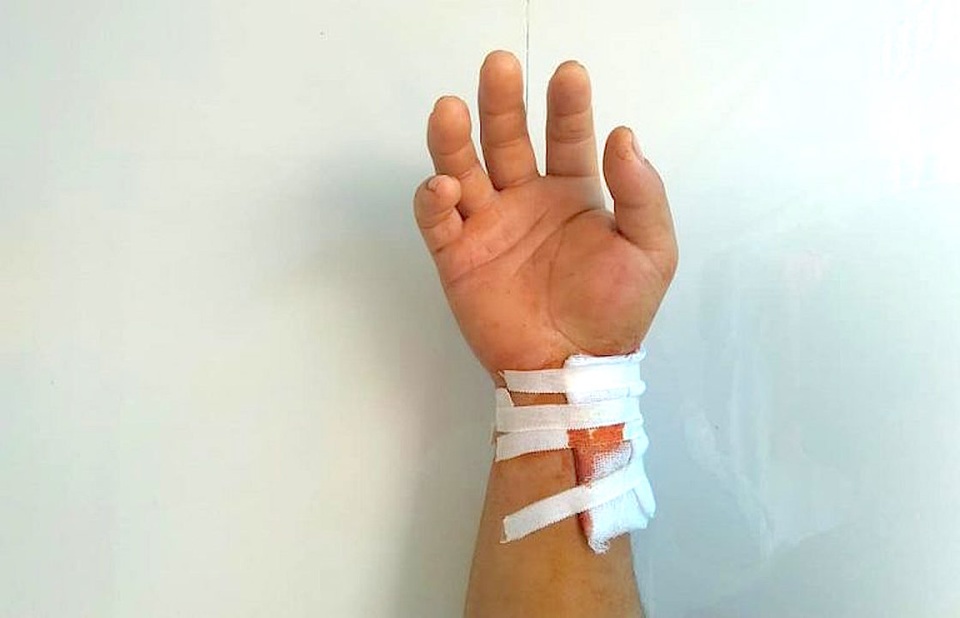 Nam thanh niên nghịch súng kíp, 5 viên đạn nổ găm vào cổ tay - 3 Nam thanh niên nghịch súng kíp, 5 viên đạn nổ găm vào cổ tay - 3