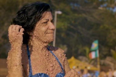 Bà mẹ dũng cảm diện bikini dù "bong bóng da" nổi khắp người