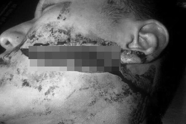 Nam sinh bị rạch mặt dã man, lên Facebook kêu gọi cảnh giác