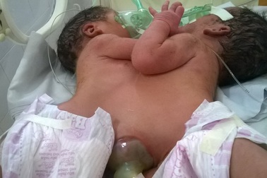 Bộ trưởng Bộ Y tế kêu gọi hỗ trợ cặp song sinh dính liền