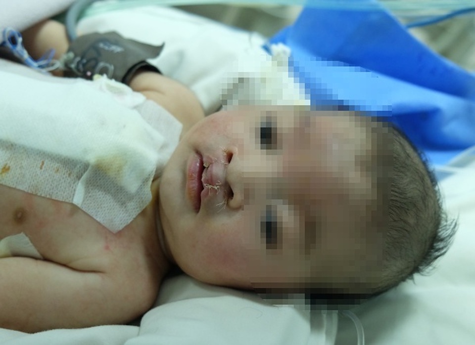 Thực hiện 2 ca mổ cùng lúc cứu bé trai bị suy tim, khe hở môi rộng - 2 Thực hiện 2 ca mổ cùng lúc cứu bé trai bị suy tim, khe hở môi rộng - 2