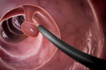 Khi nào cần sàng lọc polyp và ung thư đại trực tràng?