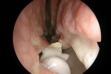 Kì lạ người đàn ông có răng mọc… trong mũi