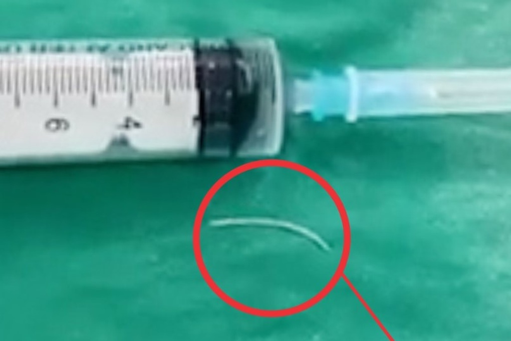 Xương cá găm vào lưỡi lúc ăn cơm, 20 ngày sau mới phát hiện nhiễm trùng - 1 Xương cá găm vào lưỡi lúc ăn cơm, 20 ngày sau mới phát hiện nhiễm trùng - 1