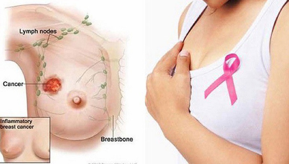 Có những yếu tố này chị em cần đặc biệt cảnh giác với ung thư vú - 1 Có những yếu tố này chị em cần đặc biệt cảnh giác với ung thư vú - 1