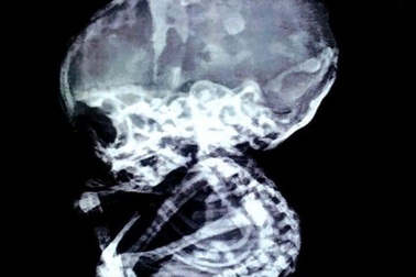 15 năm sau khi nạo thai, sốc vì bào thai vẫn còn nguyên trong bụng mẹ, hóa đá