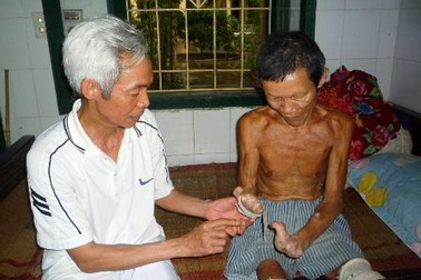 30 năm lặng thầm gắn bó với bệnh nhân phong   