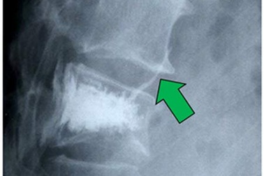 Cơ hội cho bệnh nhân lún xẹp cột sống 