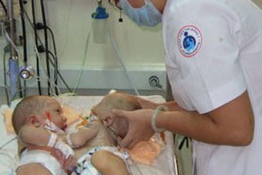 Tách thành công cặp song sinh 16 ngày tuổi dính gan 