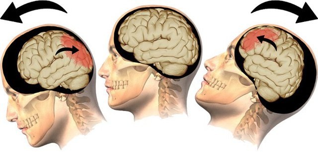 Triệu chứng chấn thương sọ não