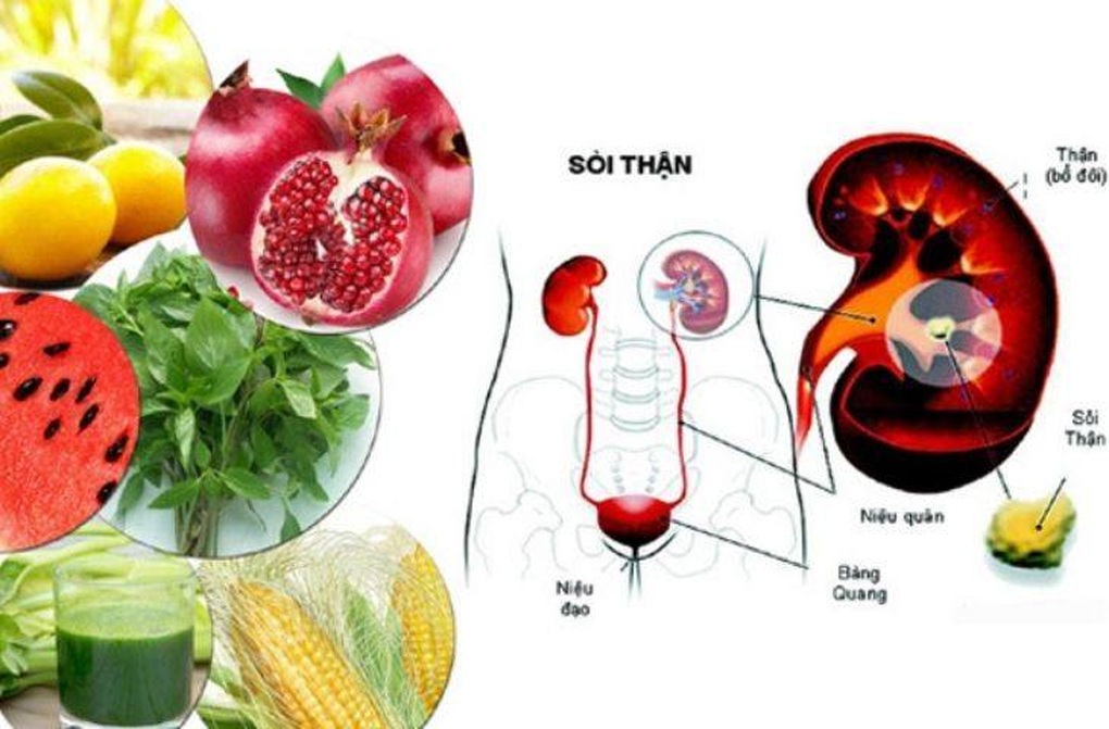 Biện pháp đơn giản hàng đầu giúp đẩy lùi sỏi thận - 1 Biện pháp đơn giản hàng đầu giúp đẩy lùi sỏi thận - 1