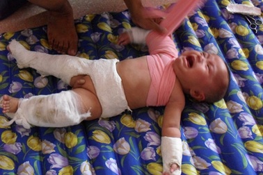 Nghẹn ngào trước cảnh cặp sinh đôi bị bệnh xương thủy tinh