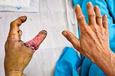 Nối thành công 2 ngón tay bị cưa máy cắt đứt