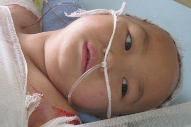 Xót thương bé thơ 4 tuổi bị bỏng nặng