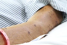 Bị ong vò vẽ đốt 120 vết, ông lão thoát chết sau 21 ngày điều trị