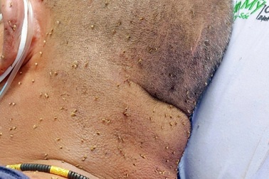 Kinh hoàng chi chít hàng trăm nọc ong trên đầu người đàn ông