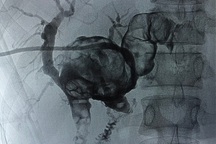 Đau bụng đi khám, người phụ nữ phát hiện sỏi đúc khuôn đầy trong gan