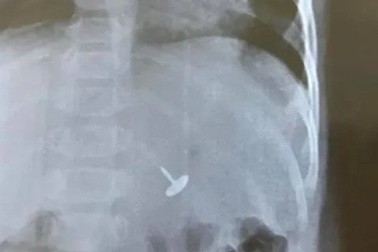 Đinh vít chui tọt vào dạ dày bé trai 11 tháng tuổi