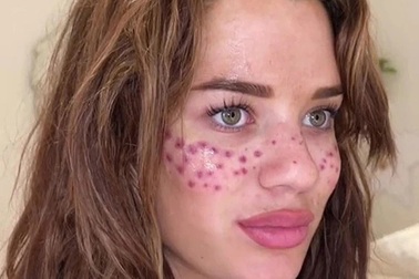 Cô gái trẻ bị mù tạm thời và sẹo vĩnh viễn trên mặt vì tự xăm tàn nhang