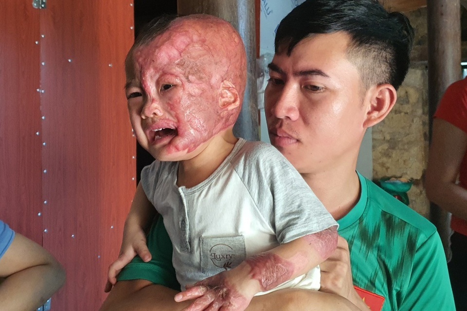 Đau nhói lòng cảnh cậu bé 2 tuổi bị bỏng xăng nặng do chơi trò sinh nhật - 8 Đau nhói lòng cảnh cậu bé 2 tuổi bị bỏng xăng nặng do chơi trò sinh nhật - 8