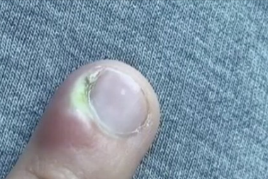 Cô gái 18 tuổi suýt phải cắt cụt ngón tay vì thói quen nhiều người mắc phải