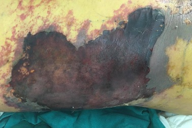 Nguy hiểm khi chữa trị tại nhà: Mũi tiêm “đoạt mạng” người đàn ông hơn 50 tuổi