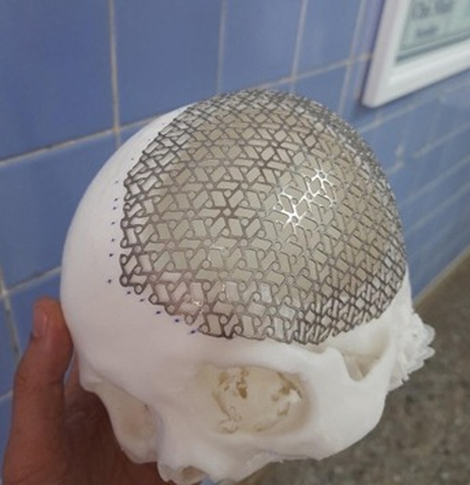 Phẫu thuật ghép sọ bằng titanium thành công cho bệnh nhân 57 tuổi - 1