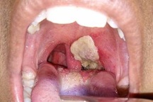 Bệnh bạch hầu - Nguyên nhân khiến 3 người chết ở Bình Phước