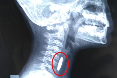 Gắp thành công đồng xu trong thực quản bé gái 5 tuổi