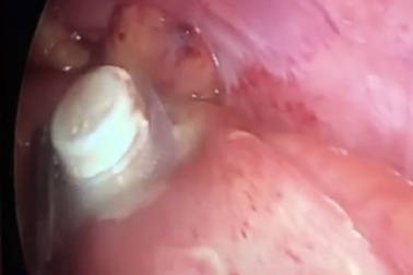 Nam bệnh nhân thủng ruột vì uống thuốc còn nguyên vỉ