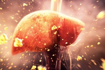 Men gan cao: Triệu chứng mơ hồ, khởi đầu của nhiều bệnh nguy hiểm