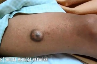 Hết hồn khối u “quái thú” giống như đôi mắt người