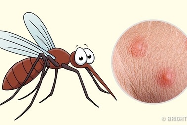 Cách phân biệt 10 vết côn trùng cắn