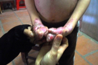 Tội nghiệp cháu bé 8 tuổi bị ly thượng bì bóng nước   