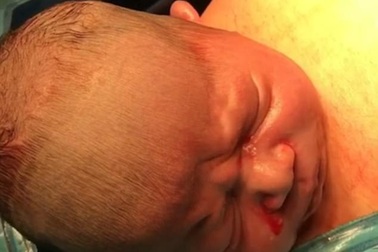 Thú vị cảnh em bé tự chui ra khỏi bụng mẹ trong ca sinh mổ