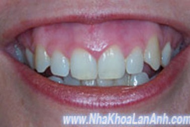 Khổ vì cười hở… lợi