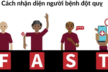 Cách nhận diện nhanh dấu hiệu người bị đột quỵ trong cộng đồng
