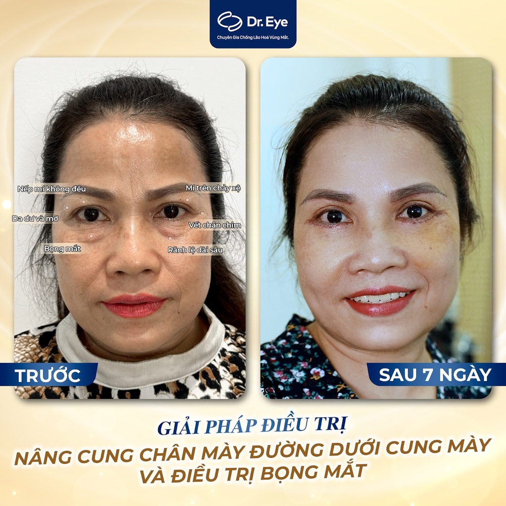 Dr. Eye - Địa chỉ điều trị bọng mắt tại TPHCM dành cho phụ nữ - 2 Dr. Eye - Địa chỉ điều trị bọng mắt tại TPHCM dành cho phụ nữ - 2