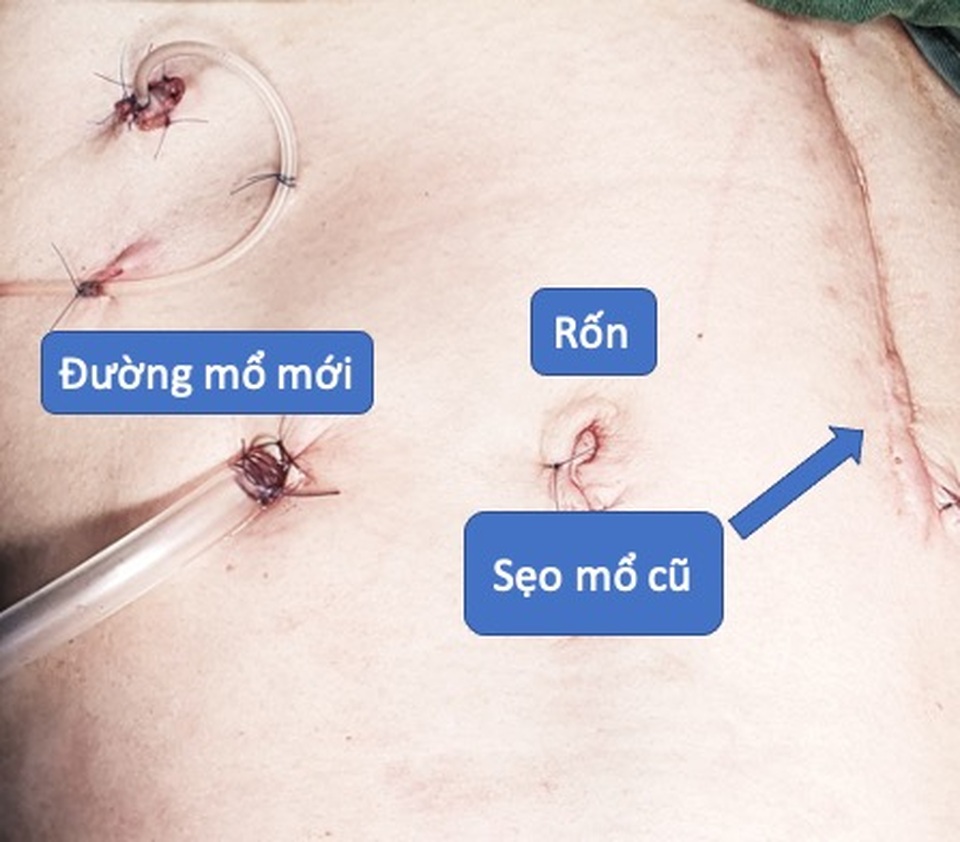 Cắt toàn bộ bàng quang bằng phương pháp nội soi phẫu thuật lớn - đường mổ nhỏ - 7 Cắt toàn bộ bàng quang bằng phương pháp nội soi phẫu thuật lớn - đường mổ nhỏ - 7