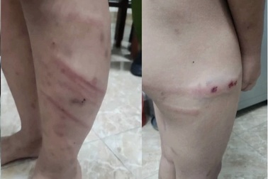 Khẩn trương điều tra vụ bé 11 tuổi nghi bị mẹ đẻ bạo hành