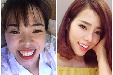 Cô gái chi 200 triệu "đập đi làm lại" khuôn mặt và giấc mơ 10 năm thành hiện thực