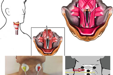 Xử trí như thế nào khi bị khàn tiếng vào mùa lạnh