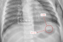 Bé 10 tháng suýt thủng ruột vì nuốt điếu thuốc lá chứa mảnh kim loại