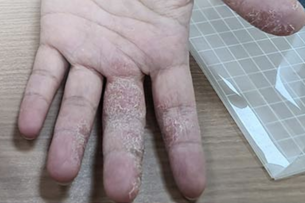 Nắng gay gắt rồi mưa bất chợt, nhiều người phát bệnh da: Đối phó thế nào? - 3 Nắng gay gắt rồi mưa bất chợt, nhiều người phát bệnh da: Đối phó thế nào? - 3