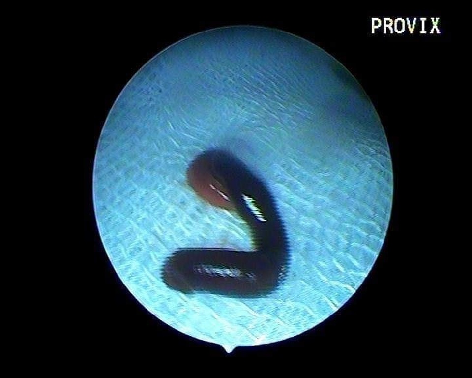 Rùng mình con đỉa dài 5cm nằm trong mũi một người phụ nữ - 2 Rùng mình con đỉa dài 5cm nằm trong mũi một người phụ nữ - 2