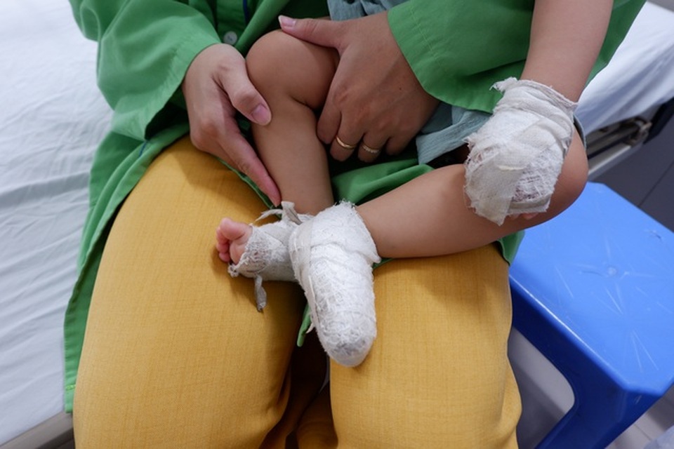 Mẹ dùng kem đánh răng chữa bỏng, bé trai phải nằm viện 4 tuần - 2 Mẹ dùng kem đánh răng chữa bỏng, bé trai phải nằm viện 4 tuần - 2