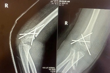 Kỹ thuật giúp bé trai 7 tuổi bị gãy tay hồi phục nhanh, không để lại sẹo